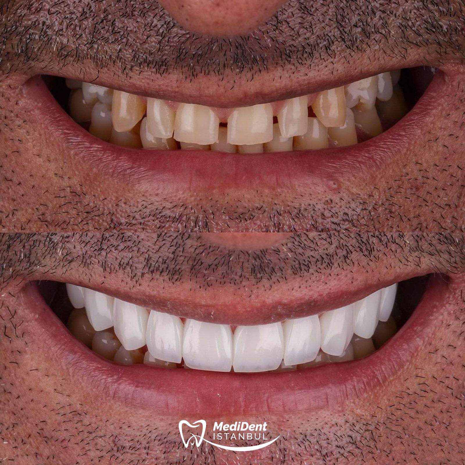 Zirkonyum kaplama — MediDent İstanbul