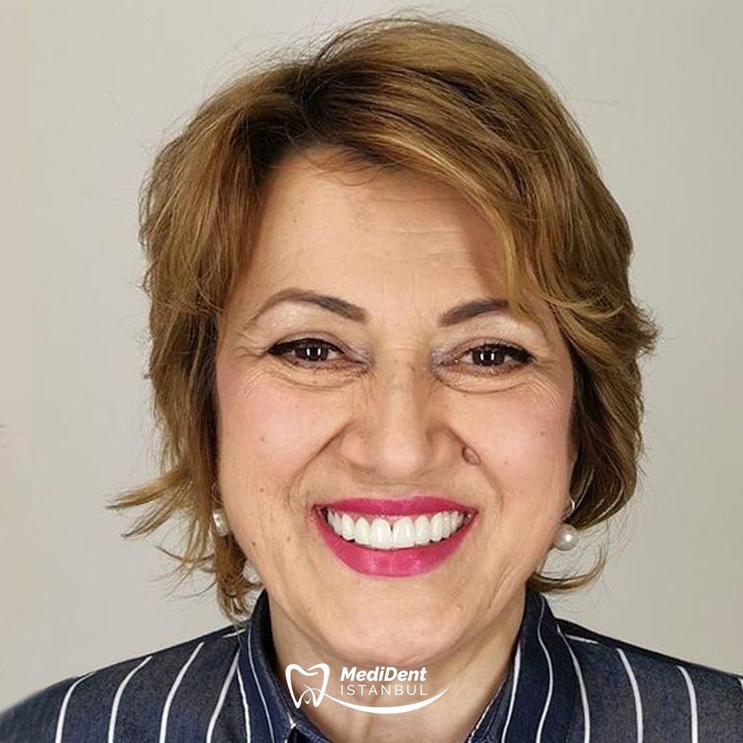 Gülüş tasarımı — MediDent İstanbul