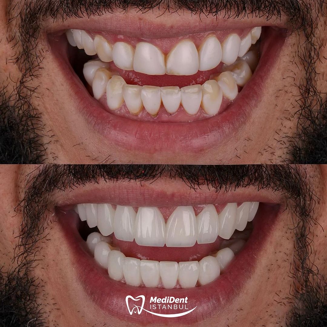 Hollywood Smile — MediDent İstanbul
