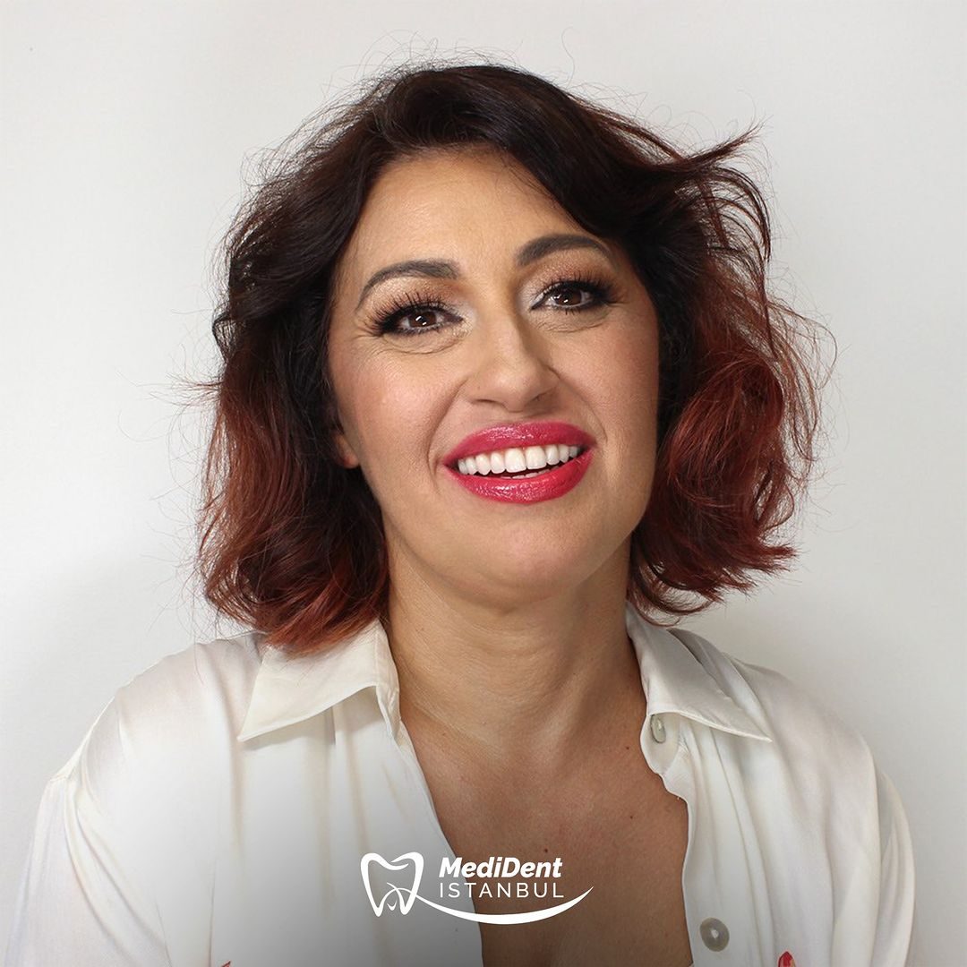 Porselen lamina — MediDent İstanbul
