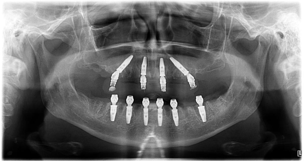Example X-ray from a real MediDent Istanbul All-on-X case